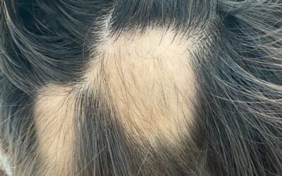 ALOPECIA