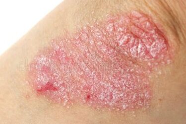 PSORIASIS