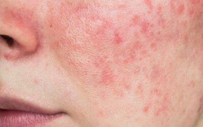 ROSACEA