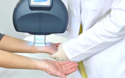 TRATAMIENTO DE VITILIGO CON EXCIMER LASER