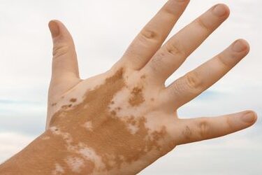 VITILIGO